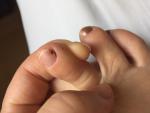Пятно на ногте, гематома или нет, помогите разобраться, пож-та фото 3