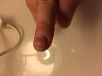 Сухой нарост на пальце руки около ногтя фото 2