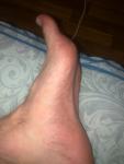 Зуд и покраснение на ступнях ног фото 3