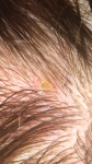 Нарост на голове светло коричневого цвета фото 1