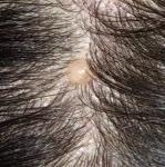Образование на волосистой части головы фото 2
