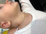 Сыпь на шеи и груди ребёнок 7 месяцев фото 1