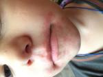 Сыпь вокруг рта у ребёнка фото 1