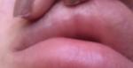 Увеличение губ гиалуроновой кислотой фото 1