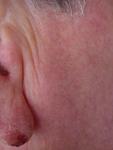 Мочка уха обезображена шелушением фото 2