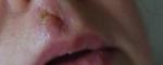Рана губы лечение фото 2