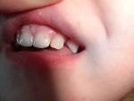 Черный налет на зубах у ребенка фото 1