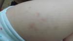Красные пятна на теле у ребенка, признаки сифилиса фото 2