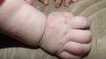 Красные пятна на теле у ребенка, признаки сифилиса фото 3