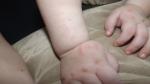 Красные пятна на теле у ребенка, признаки сифилиса фото 4