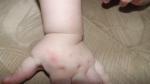 Красные пятна на теле у ребенка, признаки сифилиса фото 5