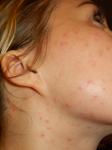 Сыпь на лице, консультация дерматолога фото 1