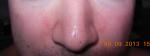 Шелушение кожи вокруг носа фото 1