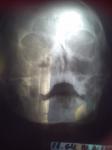 Диагностика гайморита по рентгену фото 1