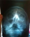 Расшифровка рентгена, гомогенное снижение пневматизации гайморовой пазухи фото 1