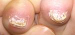 Средство от грибка на ногтях фото 1