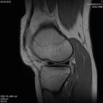 Травма колена, сделала мрт, диагноз разрыв заднего рога латерального мениска фото 1