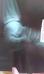 Перелом малоберцовой кости фото 1