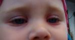 Краснота вокруг глаз у ребенка фото 1