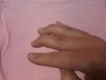 Кривой палец после травмы фото 2