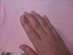 Кривой палец после травмы фото 1