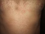 Угревая сыпь (аллергический дерматит) на теле фото 2