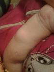 Плотная шишка на руке у ребенка фото 3