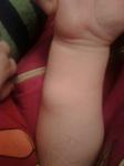 Плотная шишка на руке у ребенка фото 1