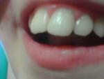 Боль в зубах отдает в десны фото 1