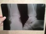 Перелом ноги диагностика онлайн фото 1