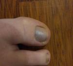 Синеют ногти на больших пальцах ног фото 1