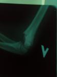 Мой сын сломал руку чуть ниже локтевого сустава со смещением фото 1