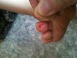 Опух палец на ноге, микробная экзема фото 1