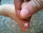 Опух палец на ноге, микробная экзема фото 2