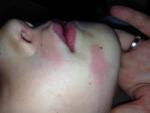 Сыпь на лице ребенка 9 лет фото 1