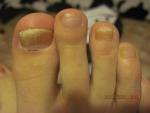 Ужасные ногти на ногах фото 1