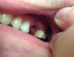 Кость царапает щеку после удаления зуба (?) фото 2