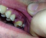 Кость царапает щеку после удаления зуба (?) фото 1