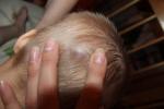 Гематома на голове у ребенка фото 1