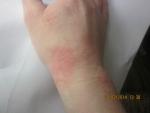 Красные пятна на руке, экзематозный дерматит фото фото 1