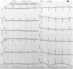 Расшифровать ЭКГ, диагноз ИБС фото 2