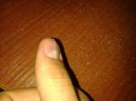 Заболевания ногтя на руке фото 1