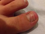 Последствия операции по удалению вросшего ногтя фото 1