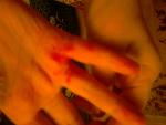 Красная сыпь между пальцами фото 2