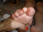 Трескаютя пальчики на ножках до крови фото 1