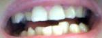 Исправление зубов фото 1