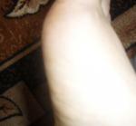 Боль подушечки большого пальца ноги фото 1