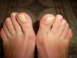 Ломкие и желтые ногти на ногах фото 1