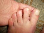 Ломкие и желтые ногти на ногах фото 2