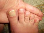 Ломкие и желтые ногти на ногах фото 3